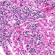 Illustration for article titled A Girl Dying From Leukemia Has Been Saved By a Version of HIV